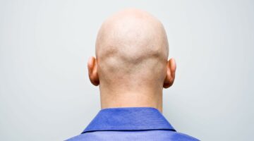✓ باحثون إسبان يطورون علاجا واعدا للصلع