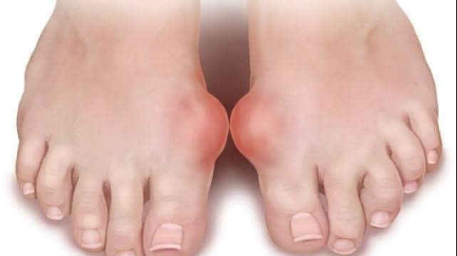 هؤلاء الأشخاص الأكثر عرضة للإصابة بمرض النقرس
