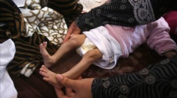 محمد ورزان وأمل.. أطفال ينهشهم التجويع الإسرائيلي