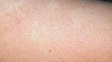جلد الدجاجة (التقرن الشعري): الأسباب، العلاجات الطبيعية، وأهم النصائح للعناية بالبشرة