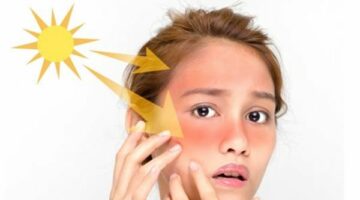 في عز الصيف.. اعرف الطرق الطبيعية لعلاج حروق الشمس