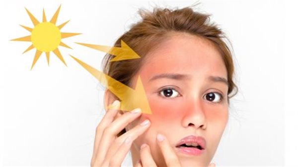 في عز الصيف.. اعرف الطرق الطبيعية لعلاج حروق الشمس