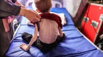 “طفولة تحت الحصار”.. سوء التغذية يهدد أطفال غزة بـ8 مضاعفات صحية ونفسية خطيرة